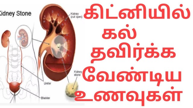 'Kidney stone diet in tamil/kidney stone foods avoid/ foods for kidney stones natural treatment'