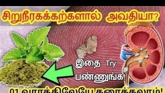 'சிறுநீரக கற்களால் அவதியா | Kidney stone treatment in Tamil | kidney stones tamil Treatment'