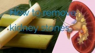 'How to remove kidney stones (Tamil) #kidney stones'