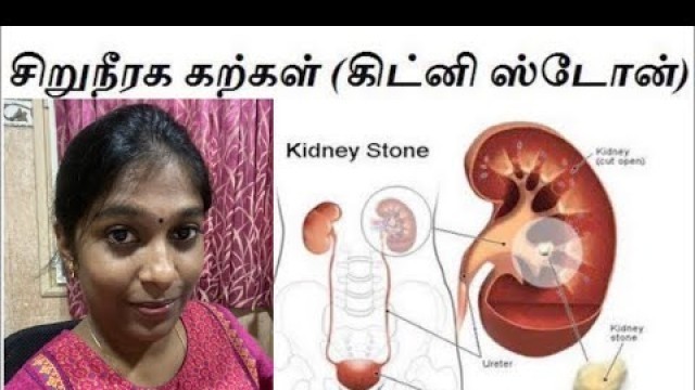 'Kidney stones  Treatment in Tamil/Homeopathic Treatment'