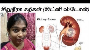 'Kidney stones  Treatment in Tamil/Homeopathic Treatment'