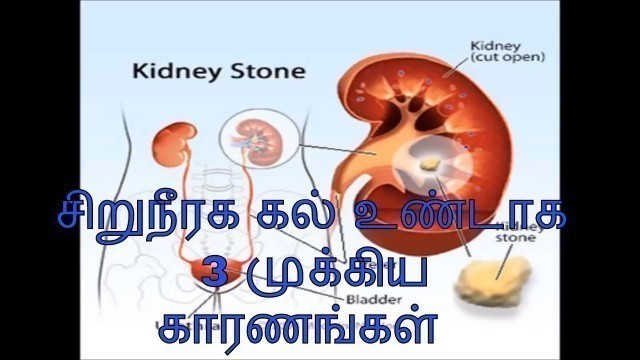 'சிறுநீரக கல் உண்டாக 3 முக்கிய காரணங்கள் | Kidney stone reasons in Tamil'