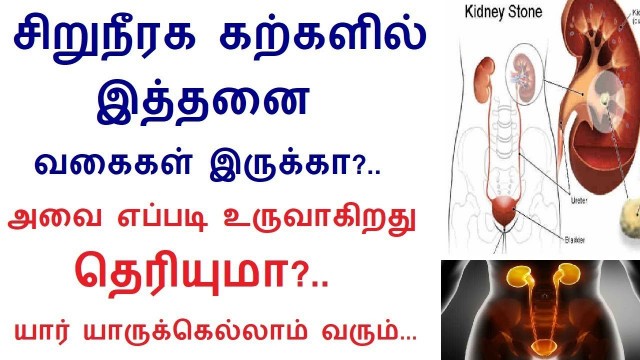 'Kidney Stone Diet: Foods to Eat and Avoid in Tamil | Rahul Kidney Health tips in Tamil'