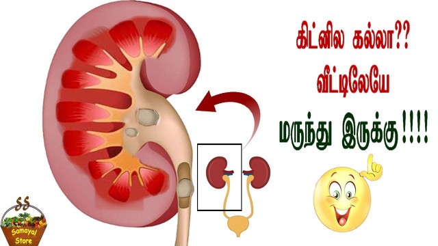 'சிறுநீரக கல் வெளியேற இத செய்ங்க!!! | Home Remedy for Kidney Stone in Tamil'