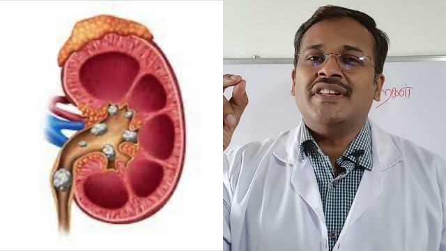 'கிட்னி கல் மருத்துவம் - kidney stones: foods and home remedies in tamil - dr karthikeyan'