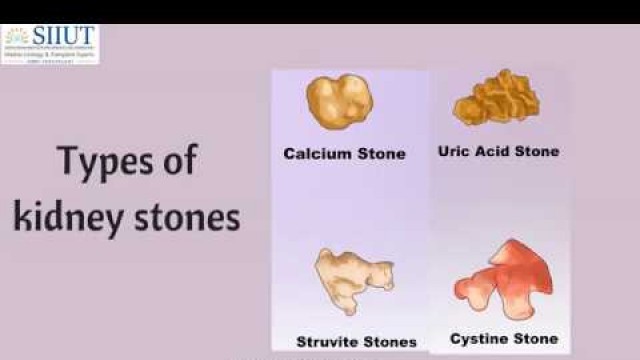 'Kidney Stone Pain Treatment In Chennai | Kidney Stone Symptoms Tamil Nadu | Urology Hospital India'