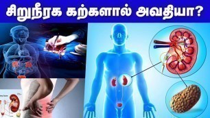 'இந்த இடத்தில் அதீத வலியா? சிறுநீரக கற்களாக இருக்கலாம் | Kidney Stone Symptoms in Tamil'