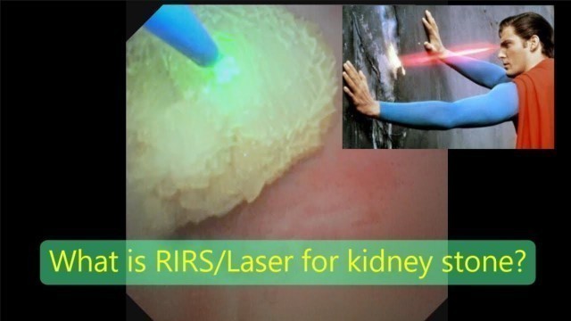 'Latest laser treatment for kidney stone - Tamil (சிறுநீரக கற்களுக்கு நவீன லேசர் சிகிச்சை) Dr.Raguram'