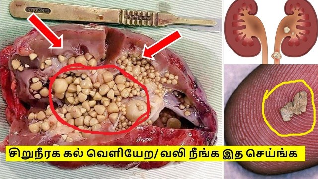 'சிறுநீரக கல் வெளியேற | வலி நீங்க இத செய்ங்க போதும் | KIDNEY STONES NATURAL TREATMENT IN TAMIL'