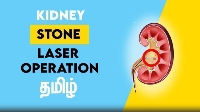 'kidney stone laser operation in Tamil | kidney stone treatment with laser | Salem Gopi Hospital'